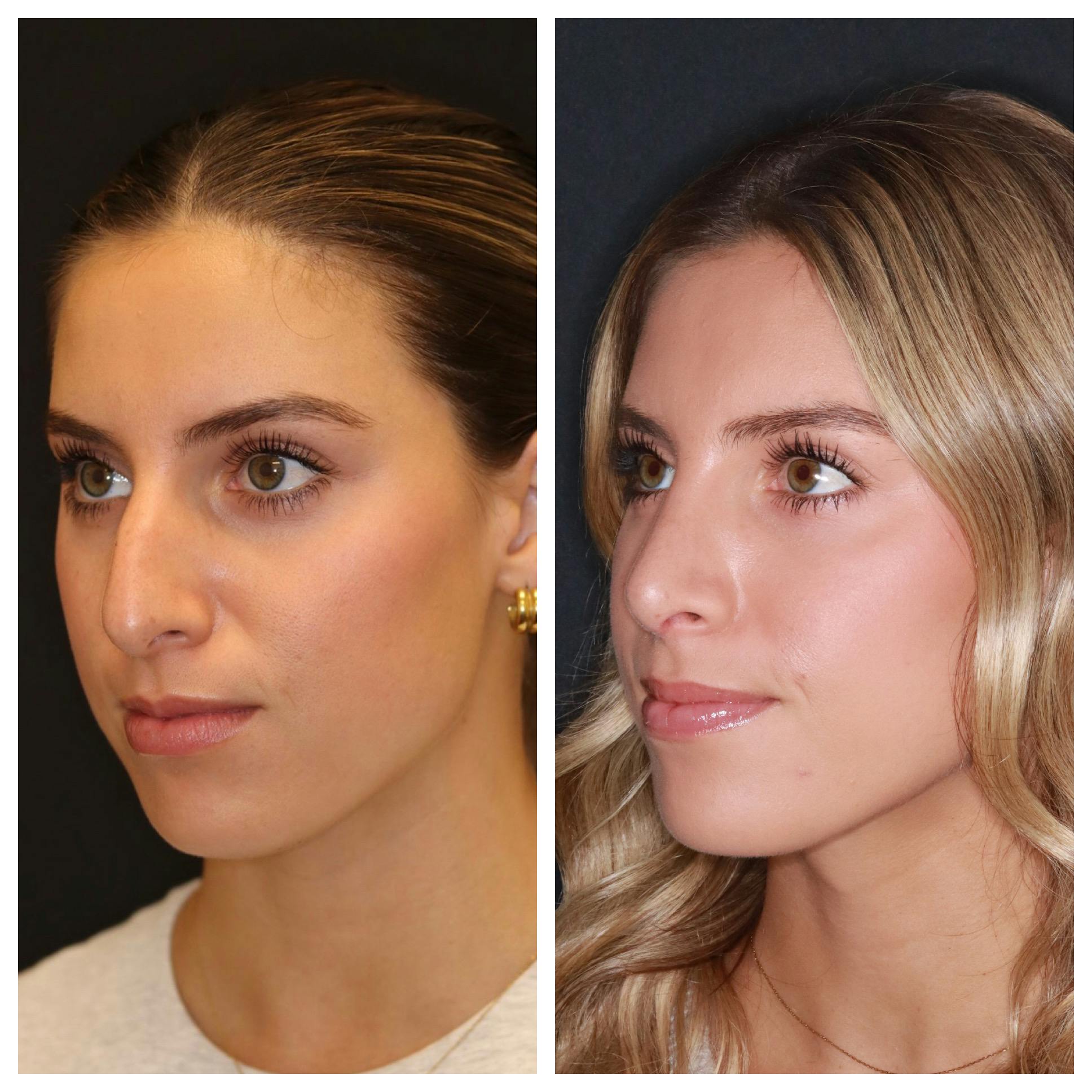 Rhinoplasty Before & After Gallery - Patient 421133 - Image 4