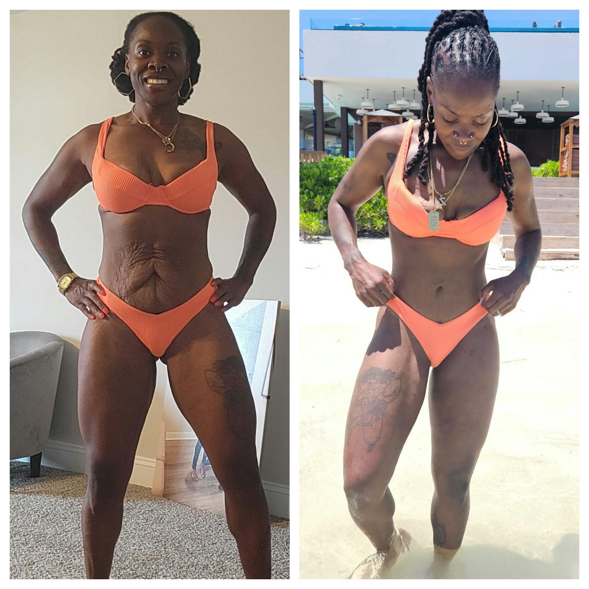 Tummy Tuck Before & After Gallery - Patient 171735 - Image 1