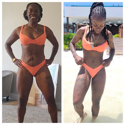 Tummy Tuck Before & After Gallery - Patient 171735 - Image 1