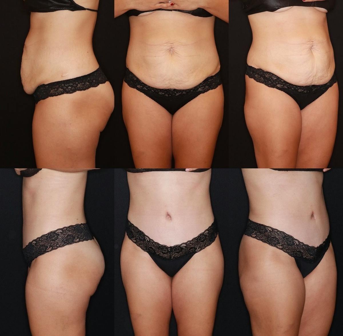 Tummy Tuck Before & After Gallery - Patient 505718 - Image 1