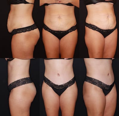 Tummy Tuck Before & After Gallery - Patient 505718 - Image 1