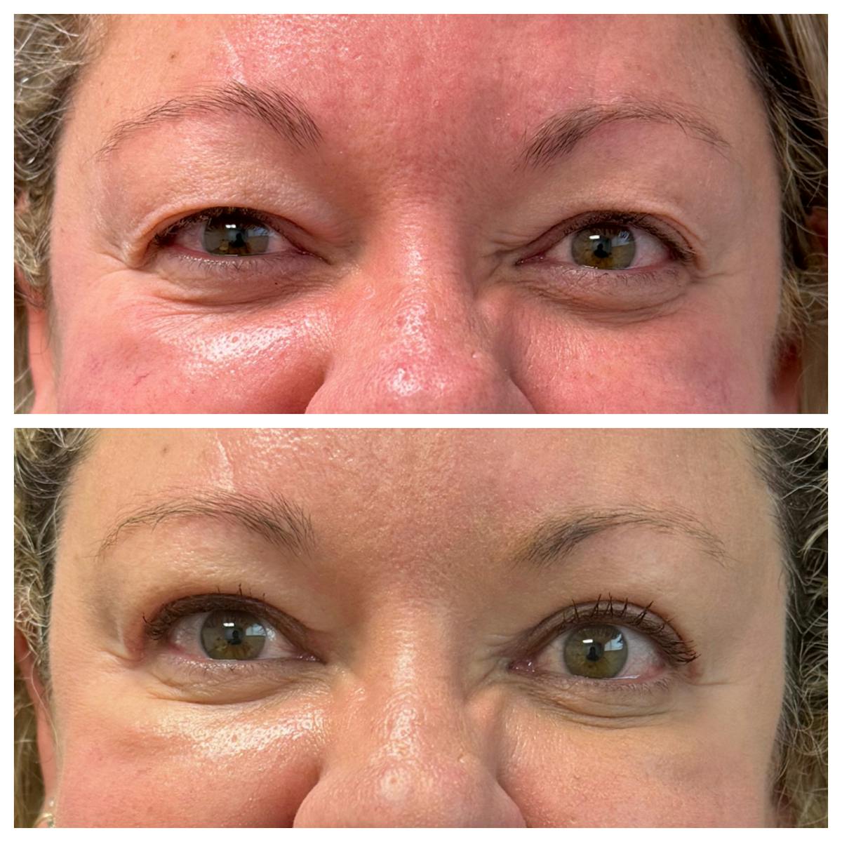 Upper Blepharoplasty Before & After Gallery - Patient 309661 - Image 1