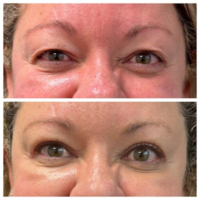 Upper Blepharoplasty Before & After Gallery - Patient 309661 - Image 1