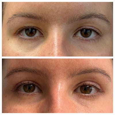 Upper Blepharoplasty Before & After Gallery - Patient 406977 - Image 1