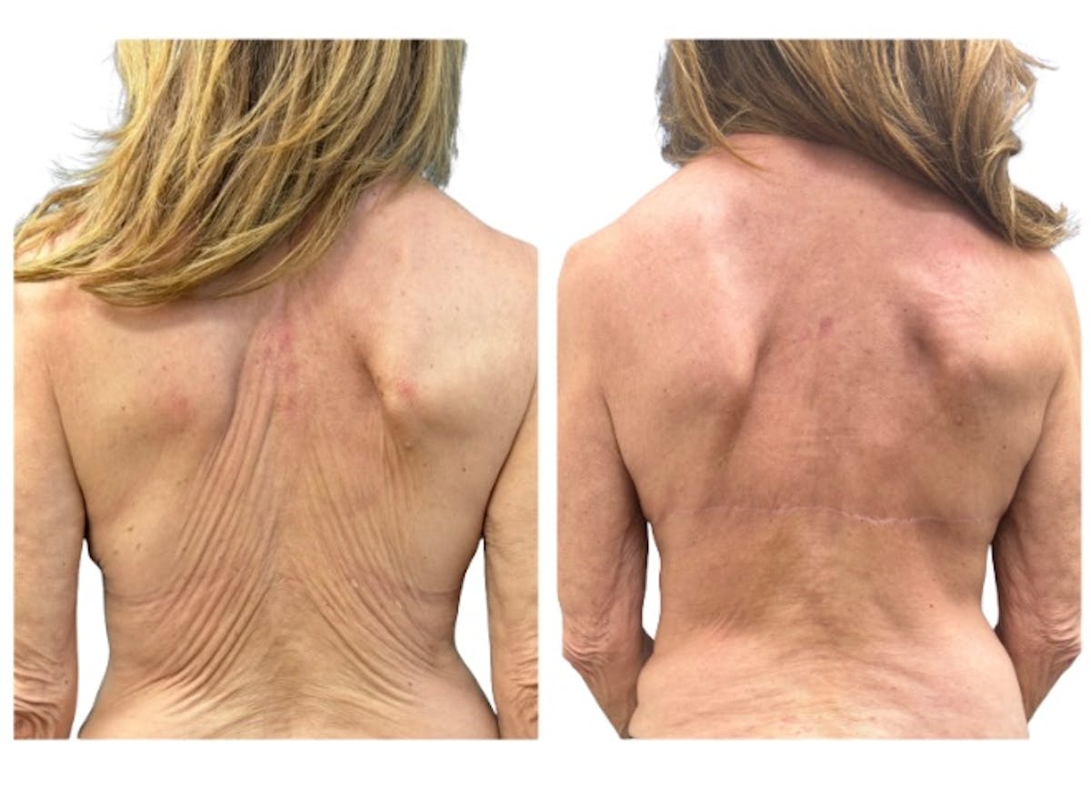 Upper Body Lift Before & After Gallery - Patient 198363 - Image 1