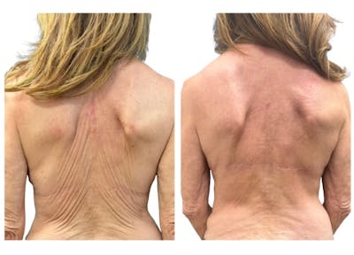 Upper Body Lift Before & After Gallery - Patient 198363 - Image 1