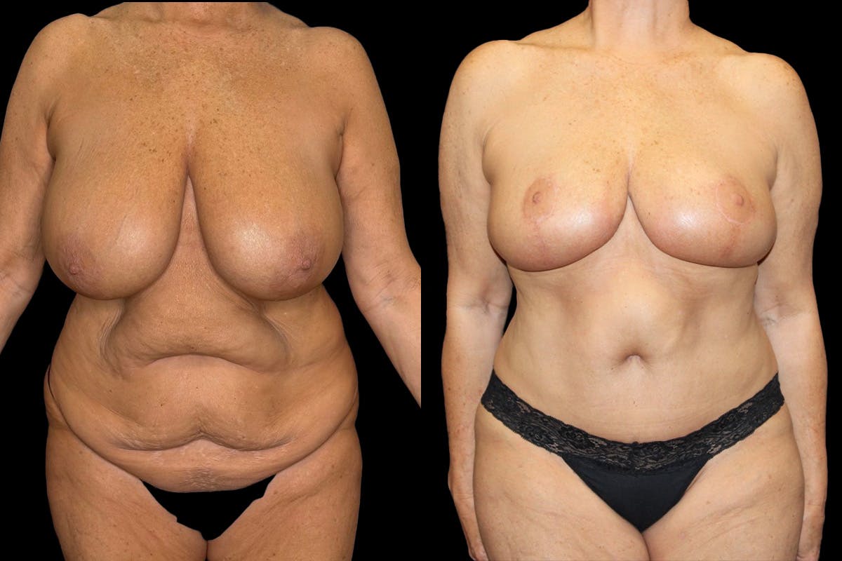 Mommy Makeover Before & After Gallery - Patient 263126 - Image 1