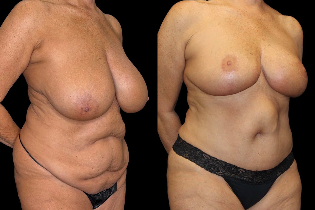 Mommy Makeover Before & After Gallery - Patient 263126 - Image 2