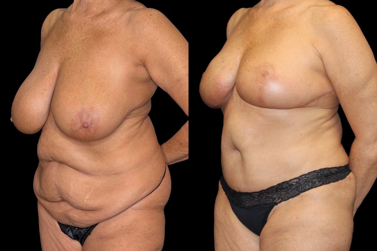 Mommy Makeover Before & After Gallery - Patient 263126 - Image 4