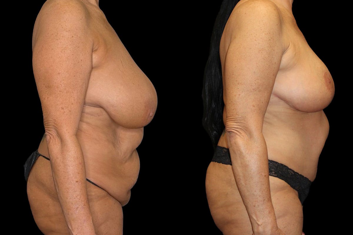 Mommy Makeover Before & After Gallery - Patient 263126 - Image 3