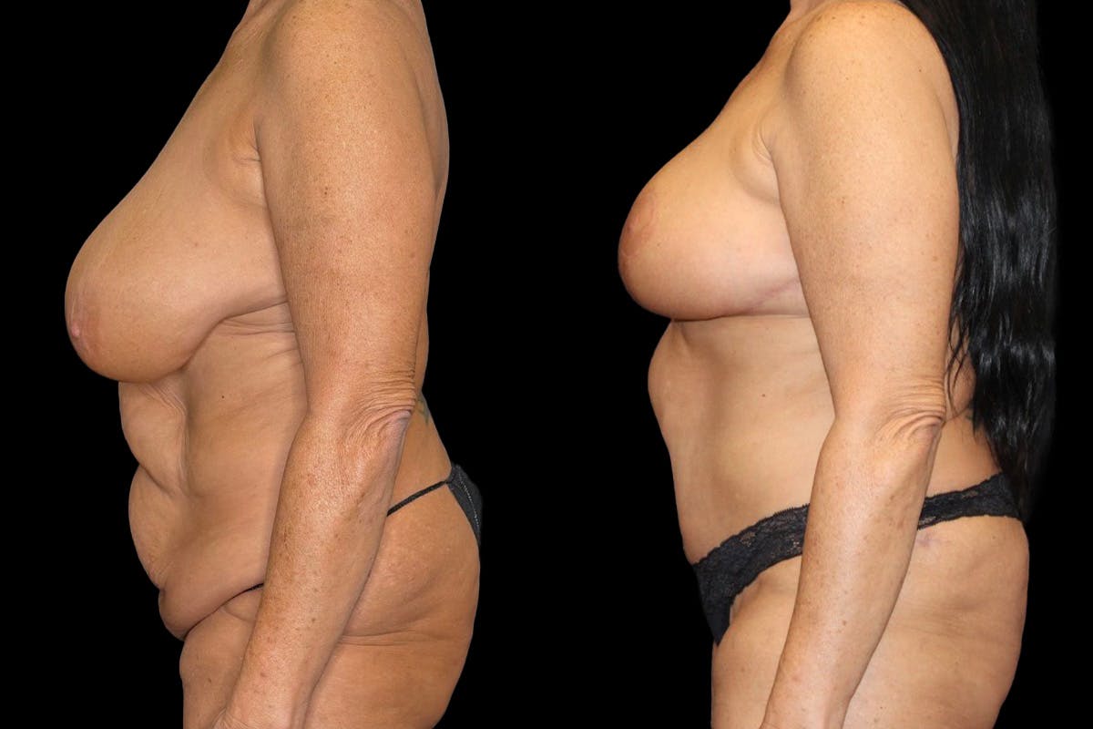 Mommy Makeover Before & After Gallery - Patient 263126 - Image 5