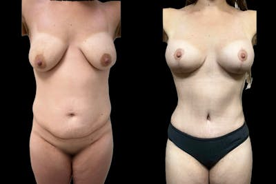 Mommy Makeover Before & After Gallery - Patient 326422 - Image 1