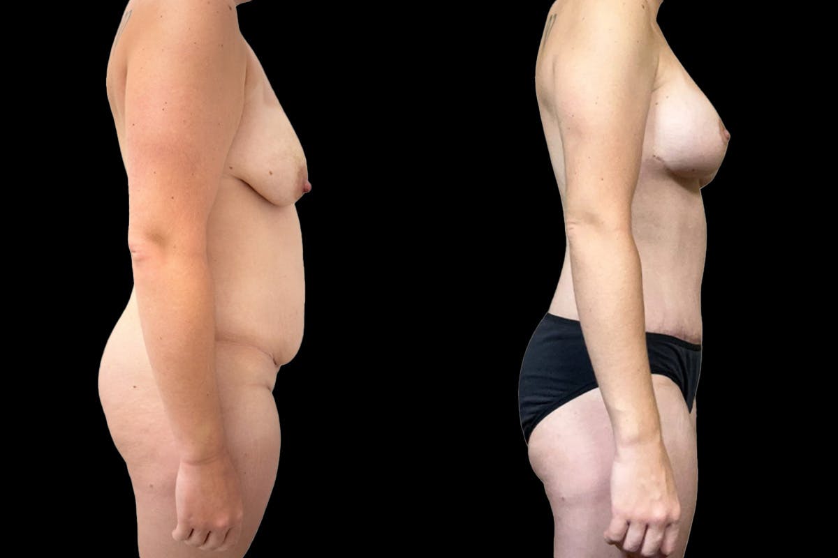 Mommy Makeover Before & After Gallery - Patient 326422 - Image 2