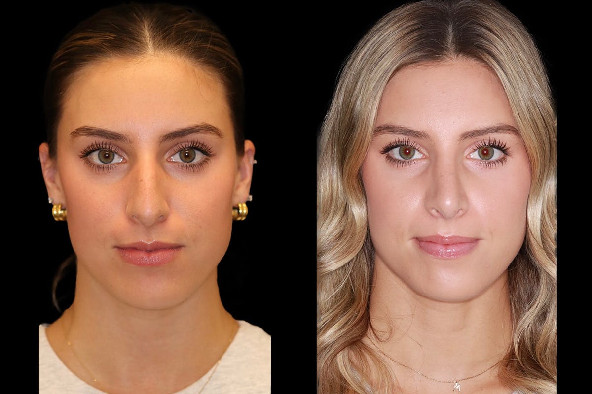 Rhinoplasty Before & After Gallery - Patient 421133 - Image 1