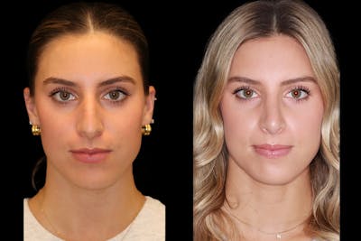 Rhinoplasty Before & After Gallery - Patient 421133 - Image 1