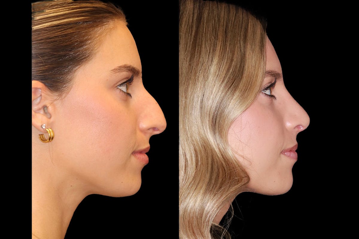 Rhinoplasty Before & After Gallery - Patient 421133 - Image 3