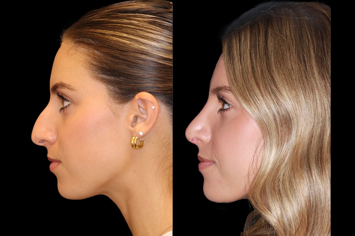Rhinoplasty Before & After Gallery - Patient 421133 - Image 5