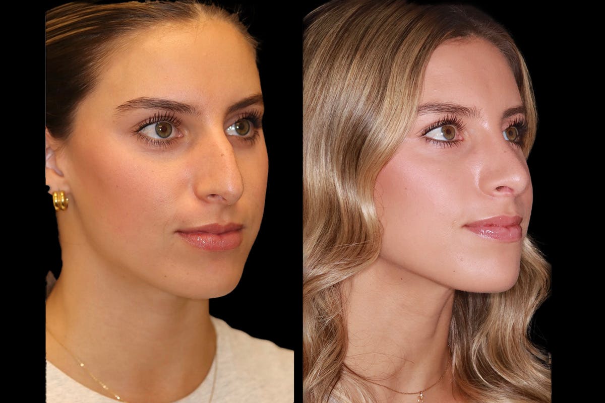 Rhinoplasty Before & After Gallery - Patient 421133 - Image 2