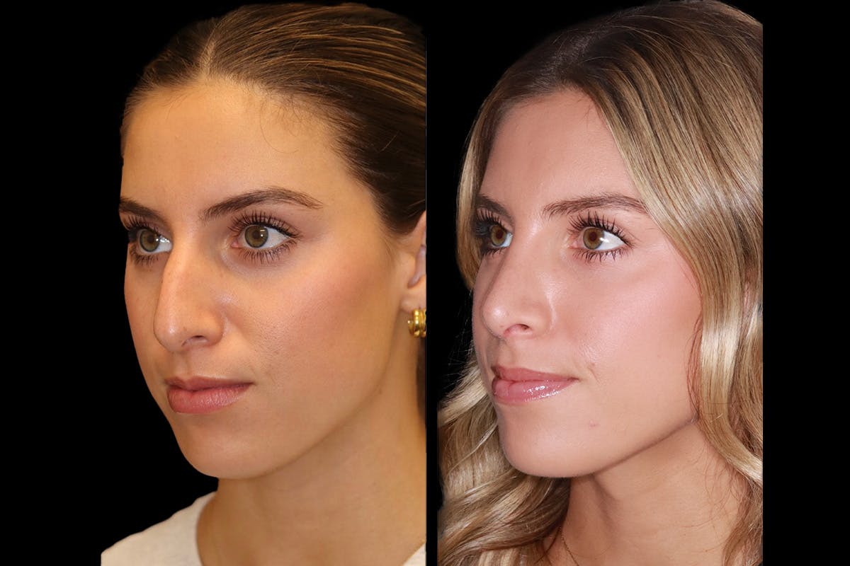 Rhinoplasty Before & After Gallery - Patient 421133 - Image 4