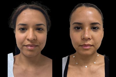 Rhinoplasty Before & After Gallery - Patient 146441 - Image 1