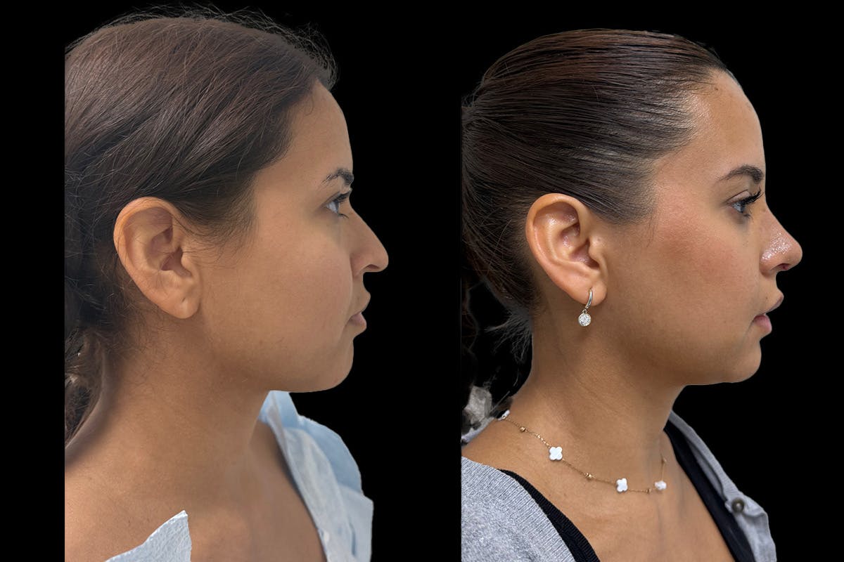Rhinoplasty Before & After Gallery - Patient 146441 - Image 2