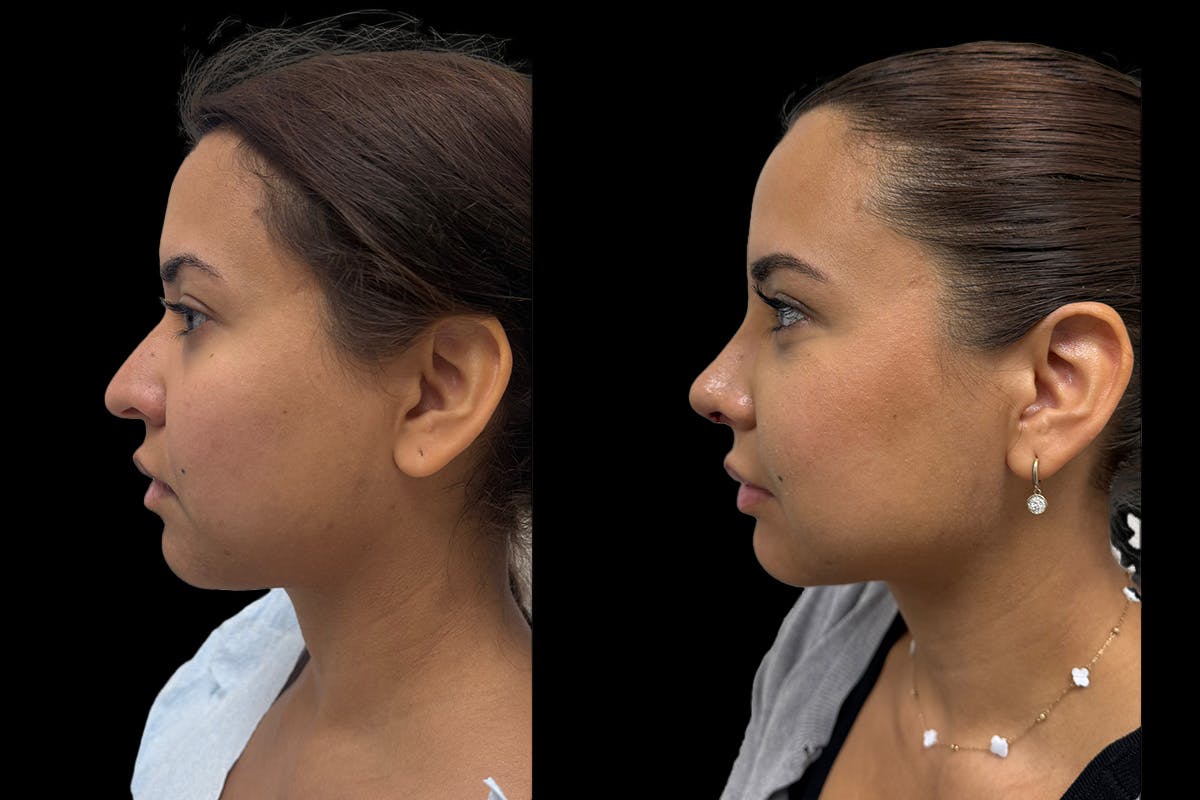 Rhinoplasty Before & After Gallery - Patient 146441 - Image 3