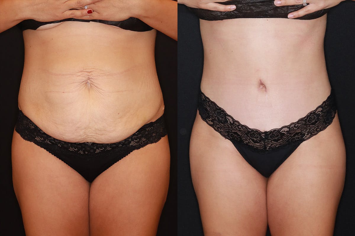Tummy Tuck Before & After Gallery - Patient 505718 - Image 1