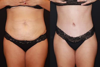 Tummy Tuck Before & After Gallery - Patient 505718 - Image 1