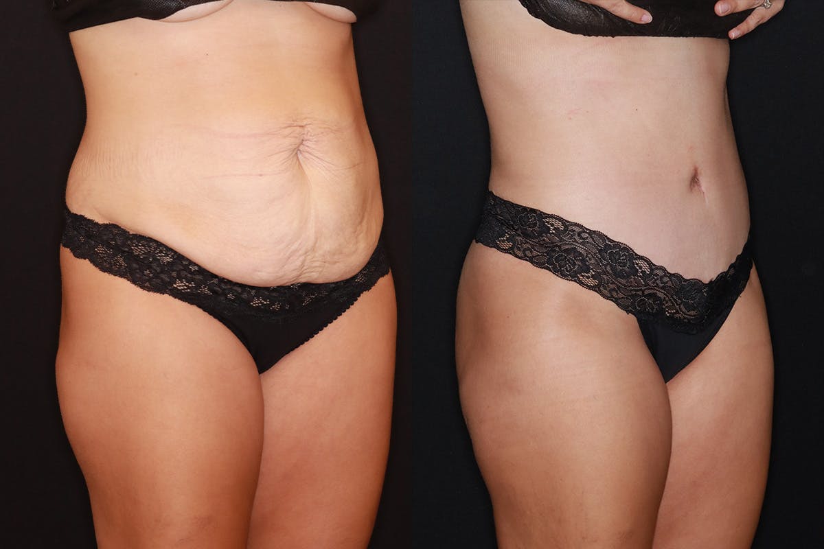 Tummy Tuck Before & After Gallery - Patient 505718 - Image 2