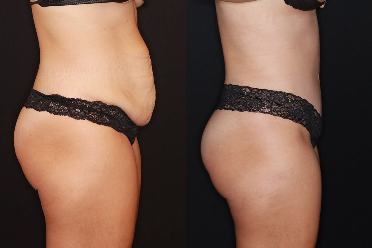 Tummy Tuck Before & After Gallery - Patient 505718 - Image 3