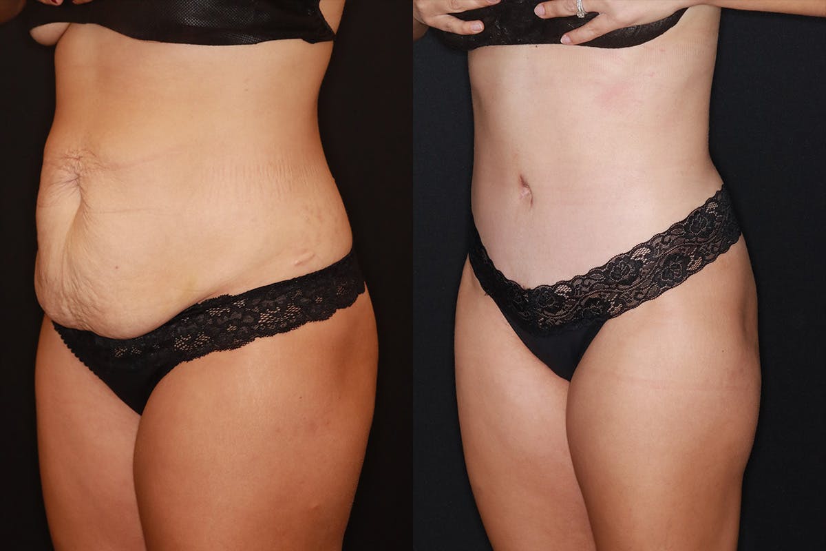 Tummy Tuck Before & After Gallery - Patient 505718 - Image 4