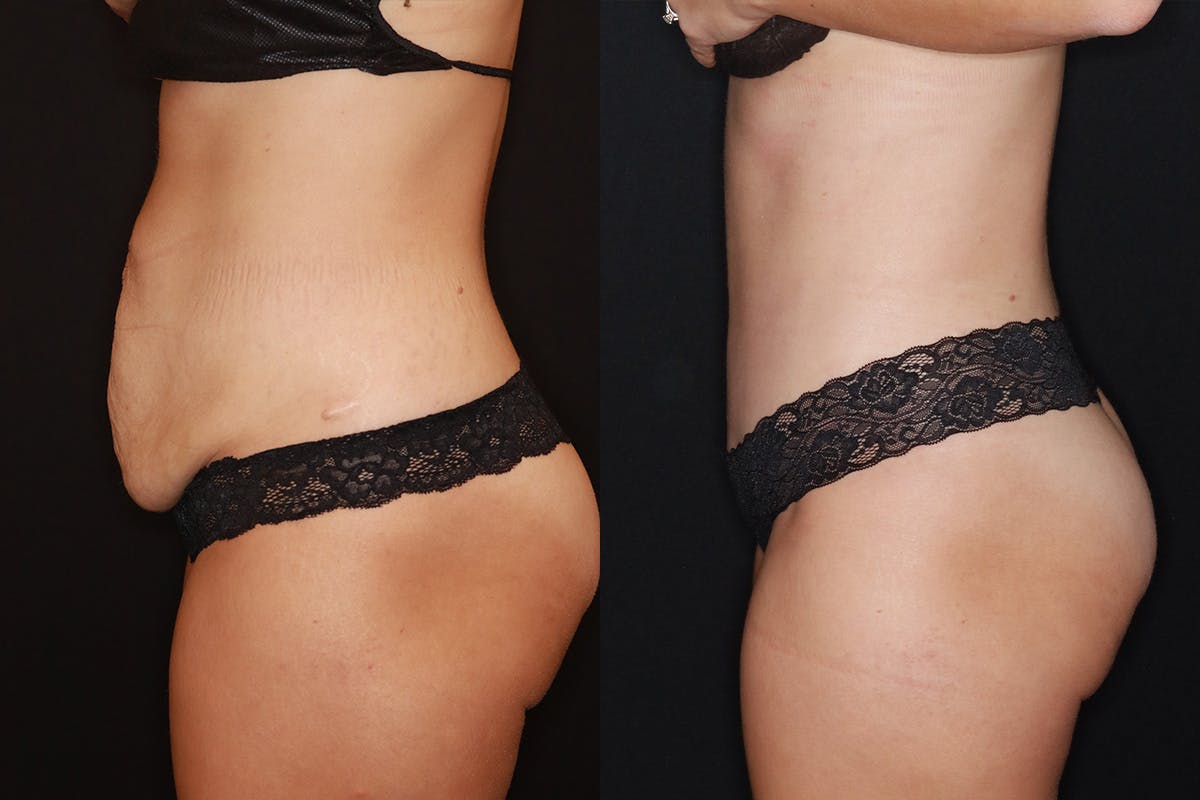 Tummy Tuck Before & After Gallery - Patient 505718 - Image 5