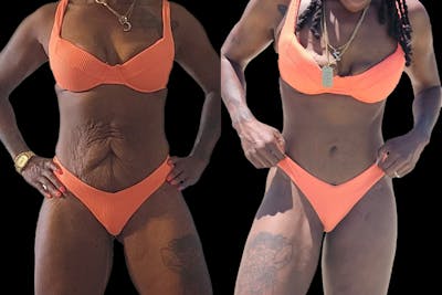 Tummy Tuck Before & After Gallery - Patient 171735 - Image 1