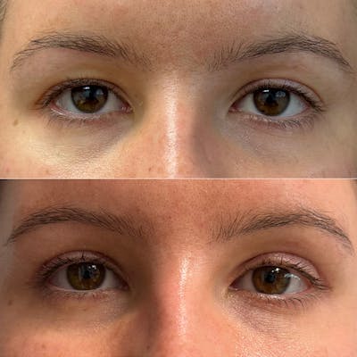 Upper Blepharoplasty Before & After Gallery - Patient 406977 - Image 1