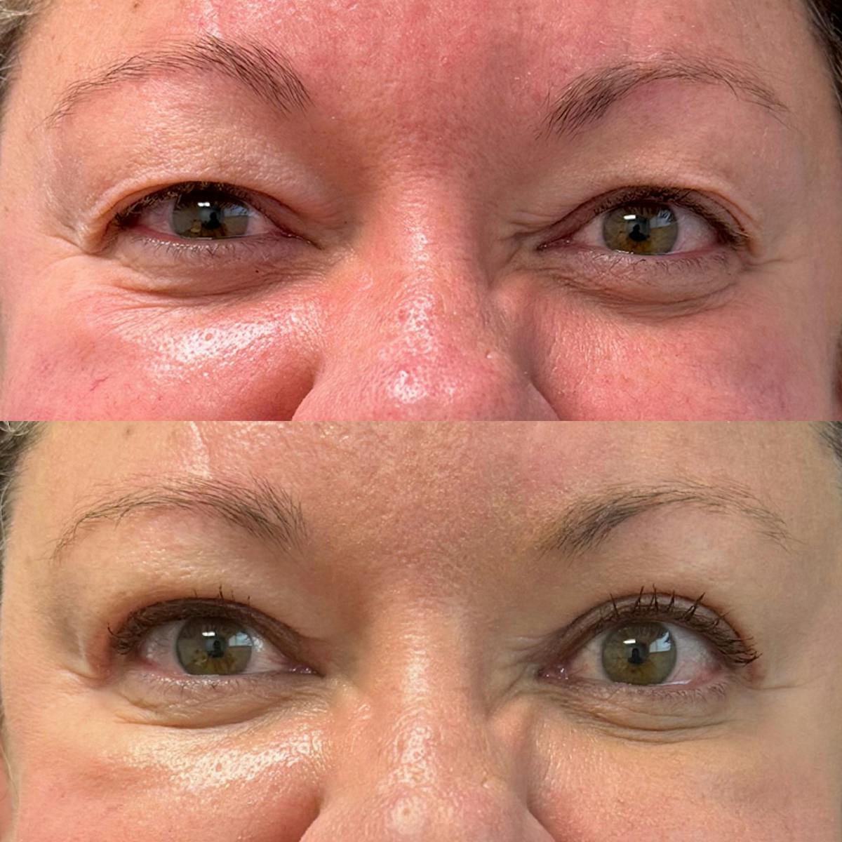 Upper Blepharoplasty Before & After Gallery - Patient 309661 - Image 1