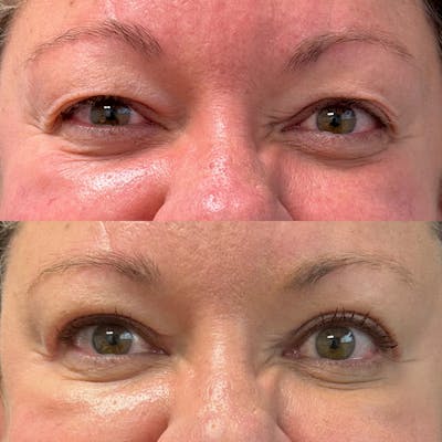 Upper Blepharoplasty Before & After Gallery - Patient 309661 - Image 1