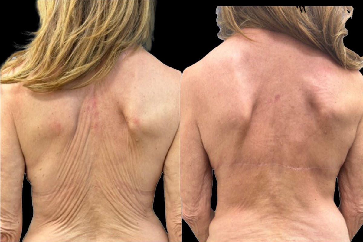 Upper Body Lift Before & After Gallery - Patient 198363 - Image 1