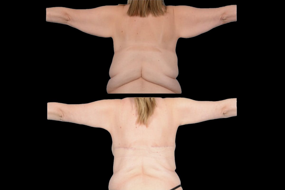 Brachioplasty Before & After Gallery - Patient 134295 - Image 1