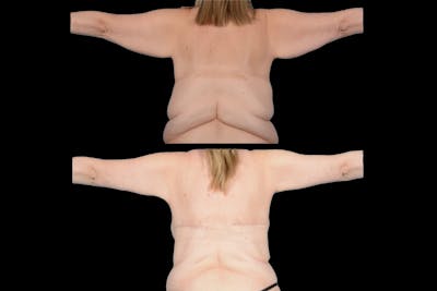 Brachioplasty Before & After Gallery - Patient 134295 - Image 1