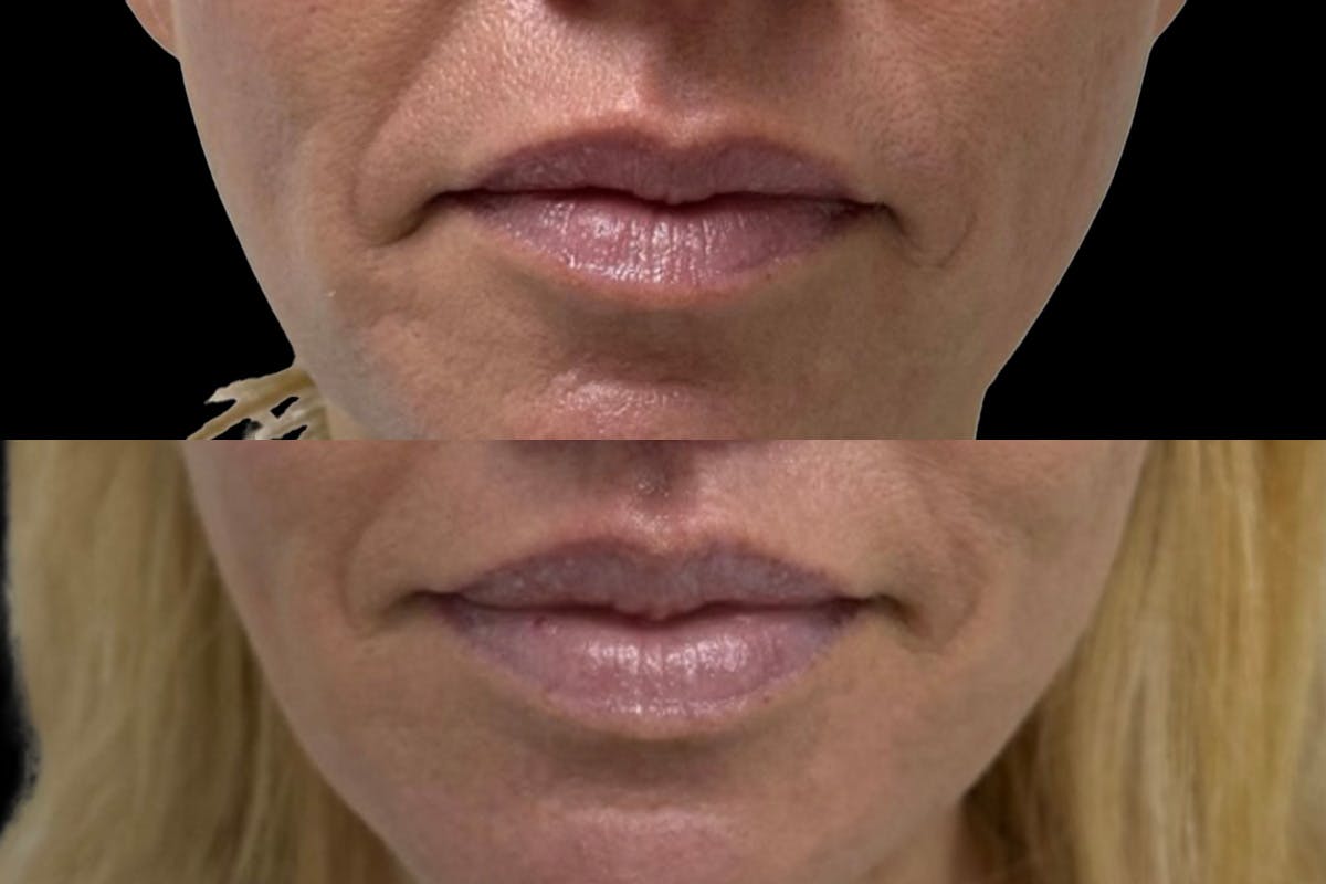 Lip Lift Before & After Gallery - Patient 347005 - Image 1
