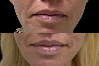 Lip Lift Before & After Gallery - Patient 347005 - Image 1