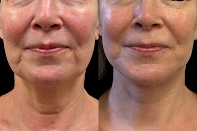 Face and Neck Lift Before & After Gallery - Patient 362502 - Image 1