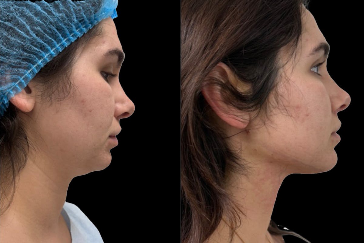 Chin Liposuction Before & After Gallery - Patient 389239 - Image 1