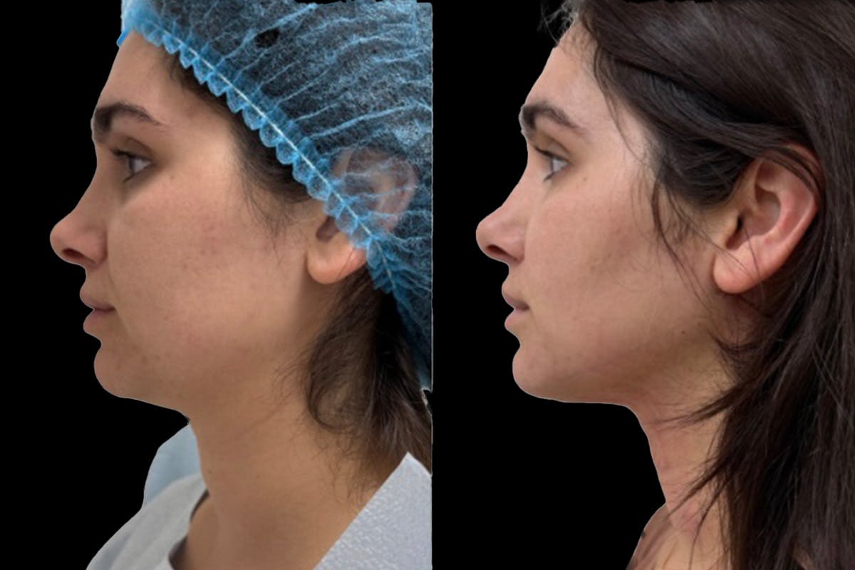 Chin Liposuction Before & After Gallery - Patient 389239 - Image 2