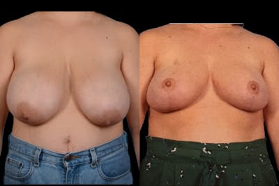 Breast Lift + Reduction Before & After Gallery - Patient 118556 - Image 1