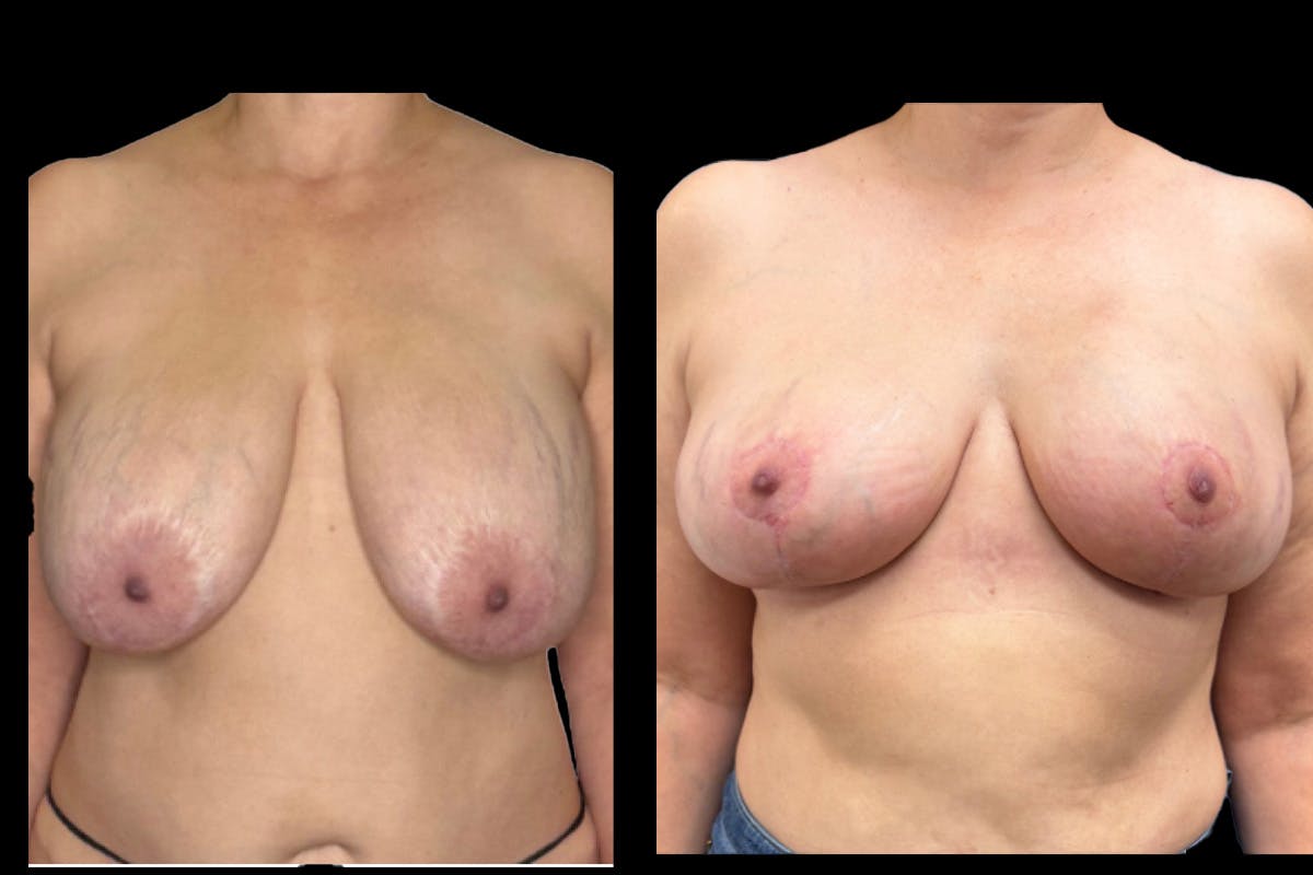 Breast Implant Explant Before & After Gallery - Patient 129564 - Image 1