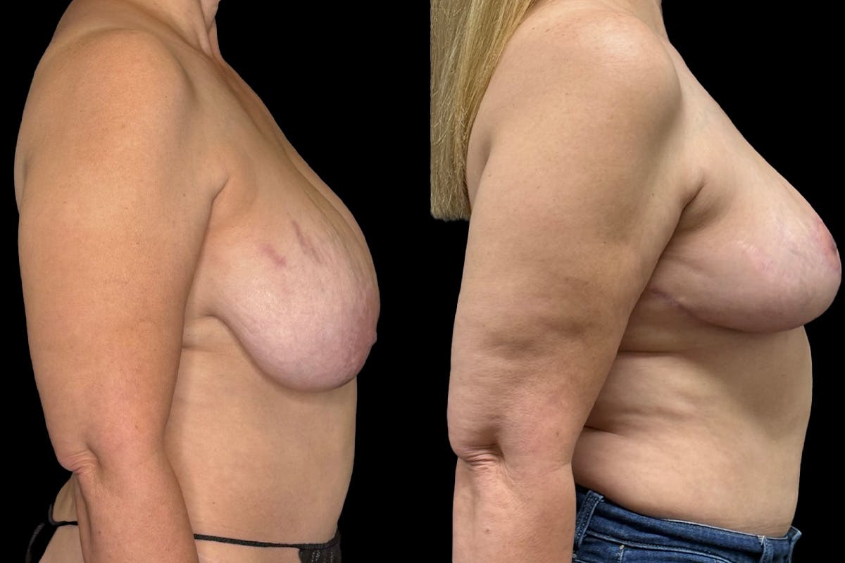 Breast Implant Explant Before & After Gallery - Patient 129564 - Image 2