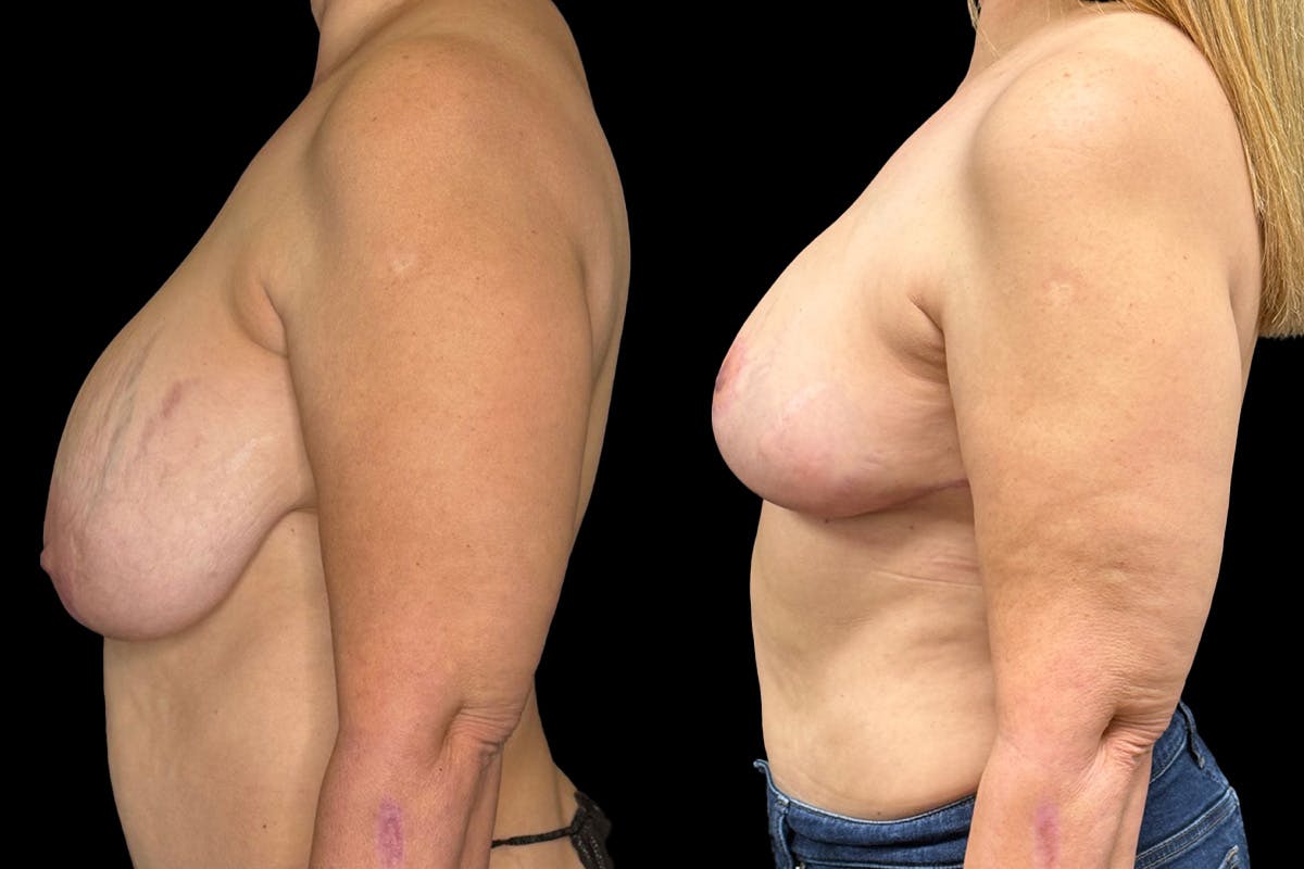 Breast Implant Explant Before & After Gallery - Patient 129564 - Image 3