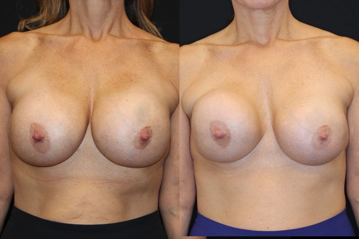 Breast Implant Exchange Before & After Gallery - Patient 276455 - Image 1
