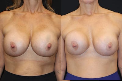 Breast Implant Exchange Before & After Gallery - Patient 276455 - Image 1